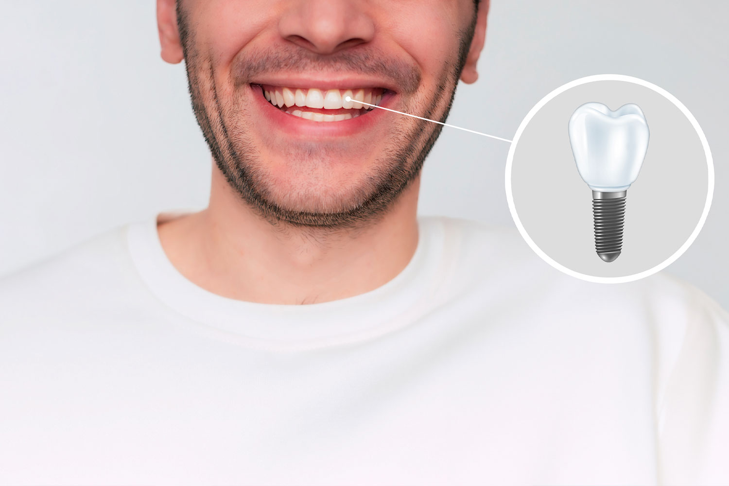 Implantologie dentaire