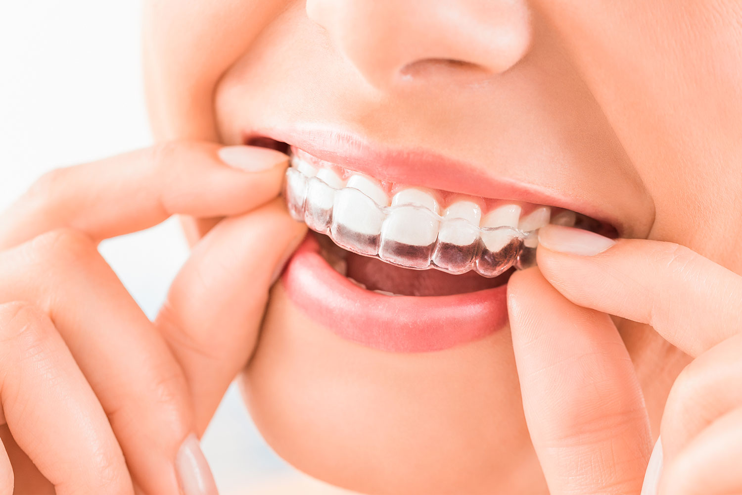 Orthodontie invisible